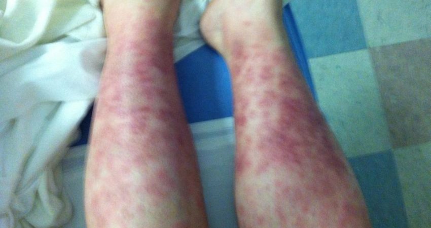 300,000 hidden vaccination effects